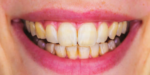 Tooth discolouration before