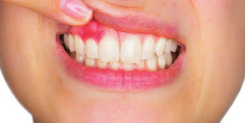 Gingivitis before