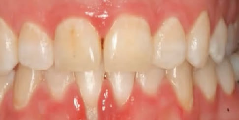 Periodontal disease before