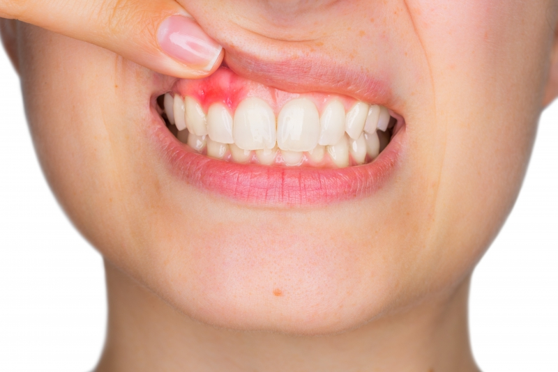 Close-up of inflamed gums